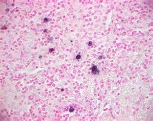 lymphomatoid granulomatosis